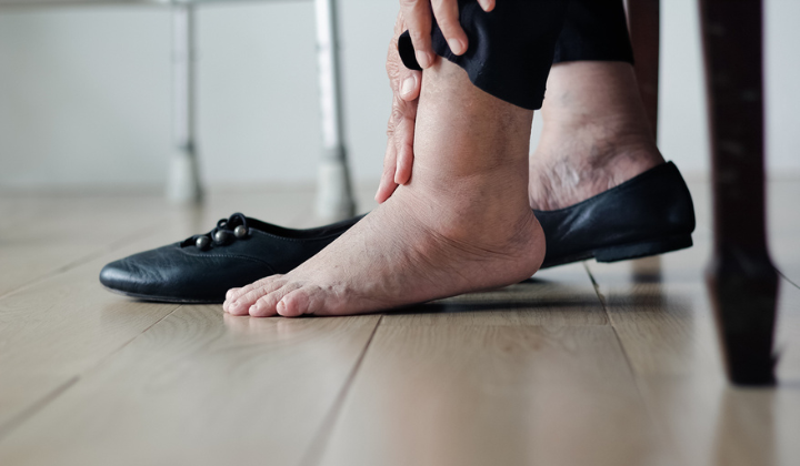 Femme ayant les pieds gonflés